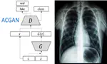 Auxiliary Classifier GAN for Covid & healthy X-rays image generation